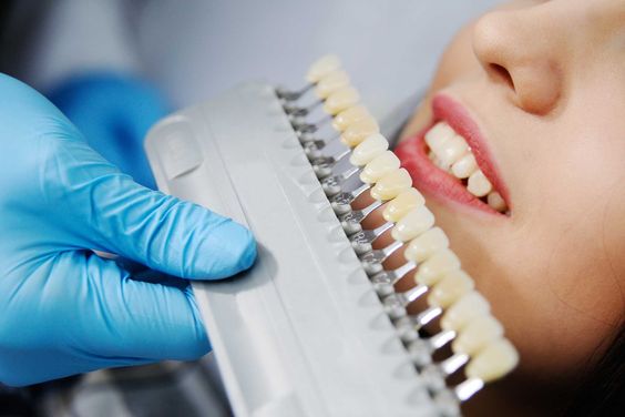 Are Dental Veneers Worth the Investment? Here’s What You Should Consider