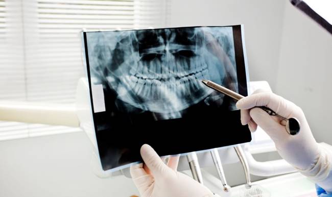 The Benefits of Digital X-rays: Faster, Safer, and More Accurate Dental Imaging