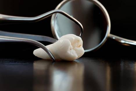 How Long Does It Take to Extract Wisdom Teeth?