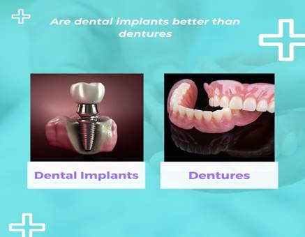 Are Dental Implants Better Than Dentures?