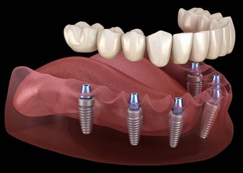 Is It Worth Getting Full Dental Implants?