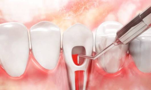 Root Canal Treatment
