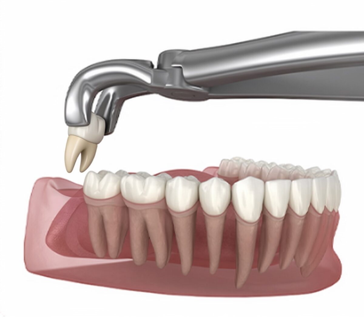 Wisom tooth extraction